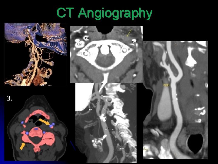 CT Angiography 