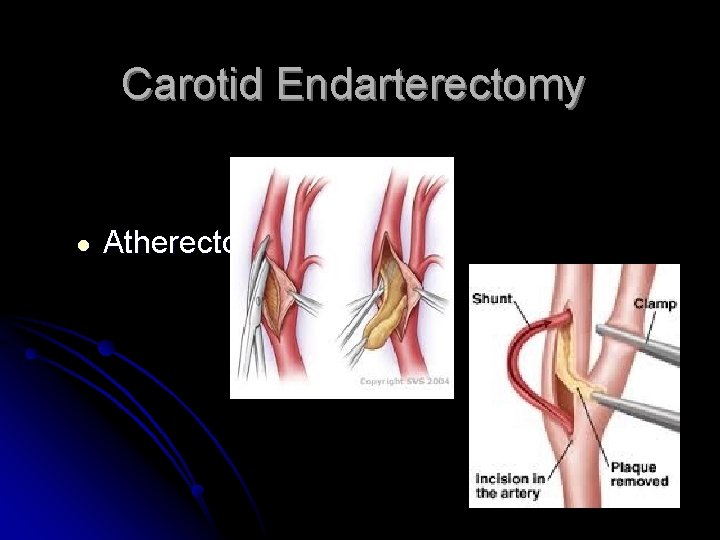 Carotid Endarterectomy ● Atherectomy 