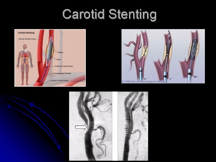 Carotid Stenting 