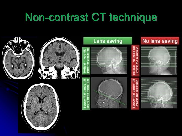 Non-contrast CT technique 
