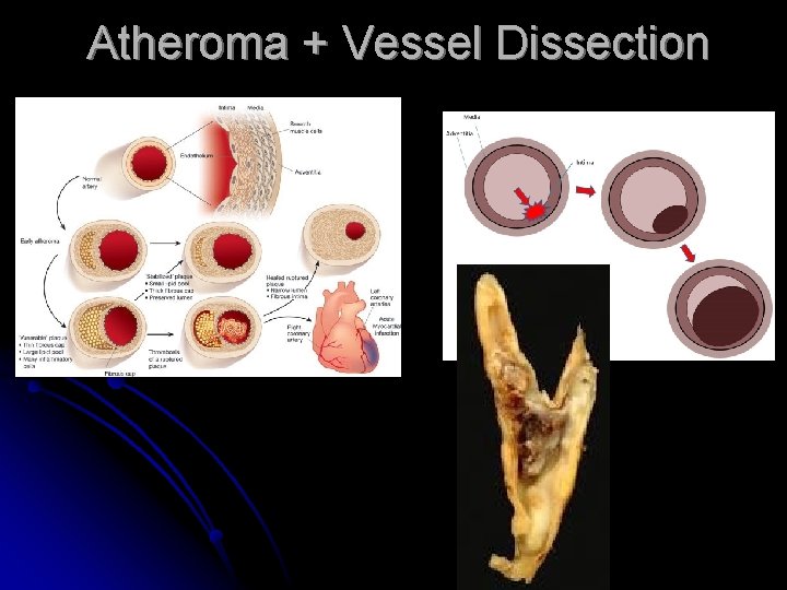 Atheroma + Vessel Dissection 