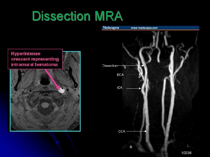 Dissection MRA 