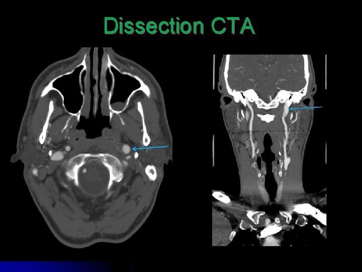 Dissection CTA 