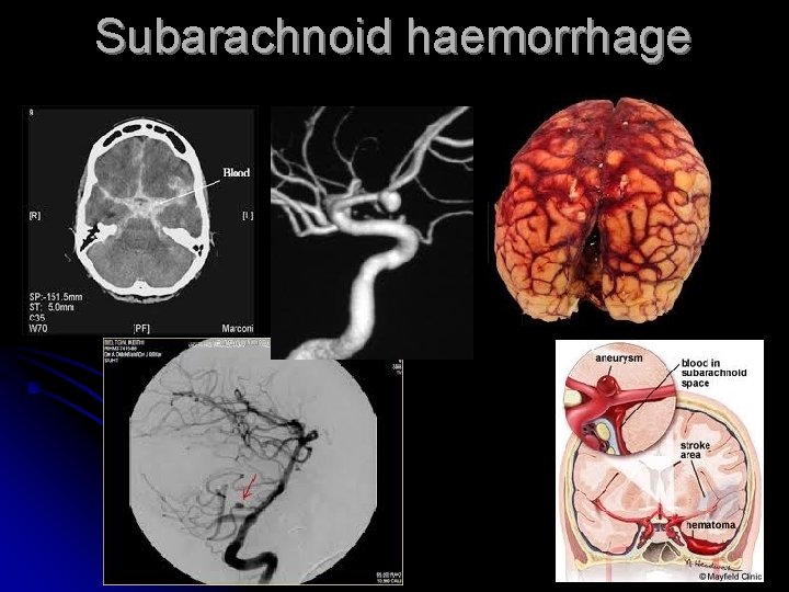 Subarachnoid haemorrhage 