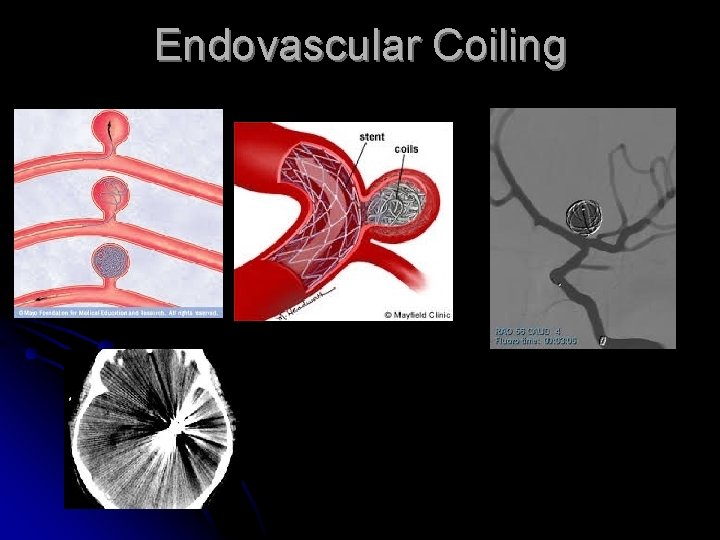 Endovascular Coiling 