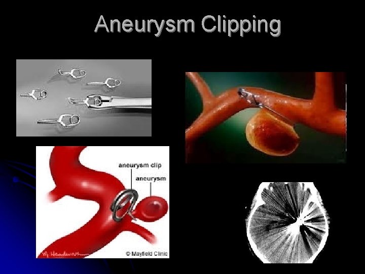 Aneurysm Clipping 