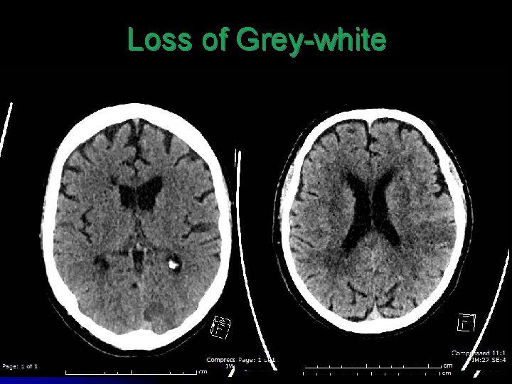 Loss of Grey-white 