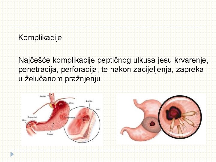 Komplikacije Najčešće komplikacije peptičnog ulkusa jesu krvarenje, penetracija, perforacija, te nakon zacijeljenja, zapreka u