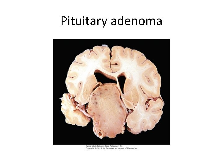 Pituitary adenoma 