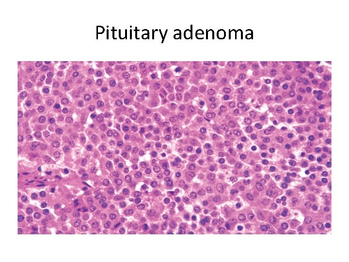 Pituitary adenoma 
