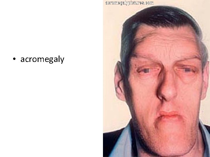  • acromegaly 