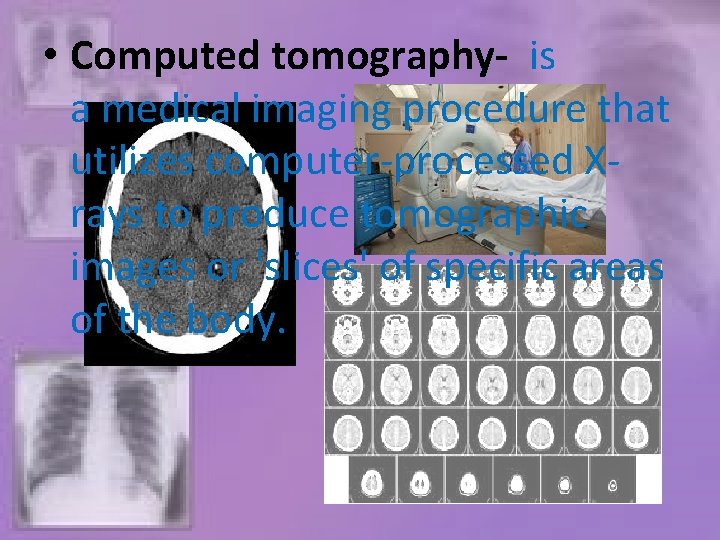  • Computed tomography- is a medical imaging procedure that utilizes computer-processed Xrays to