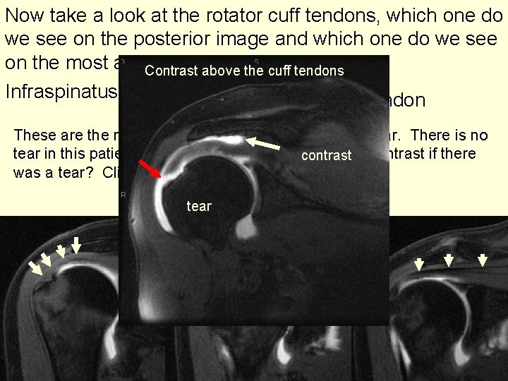 Now take a look at the rotator cuff tendons, which one do we see