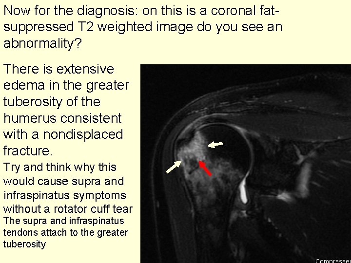 Now for the diagnosis: on this is a coronal fatsuppressed T 2 weighted image