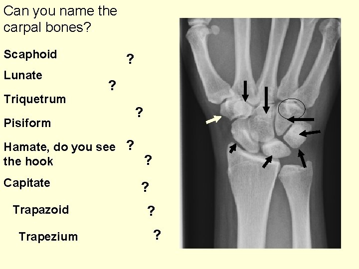 Can you name the carpal bones? Scaphoid Lunate Triquetrum Pisiform ? ? ? Hamate,