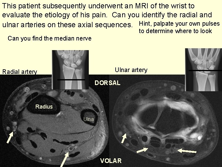 This patient subsequently underwent an MRI of the wrist to evaluate the etiology of