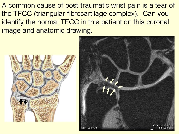 A common cause of post-traumatic wrist pain is a tear of the TFCC (triangular