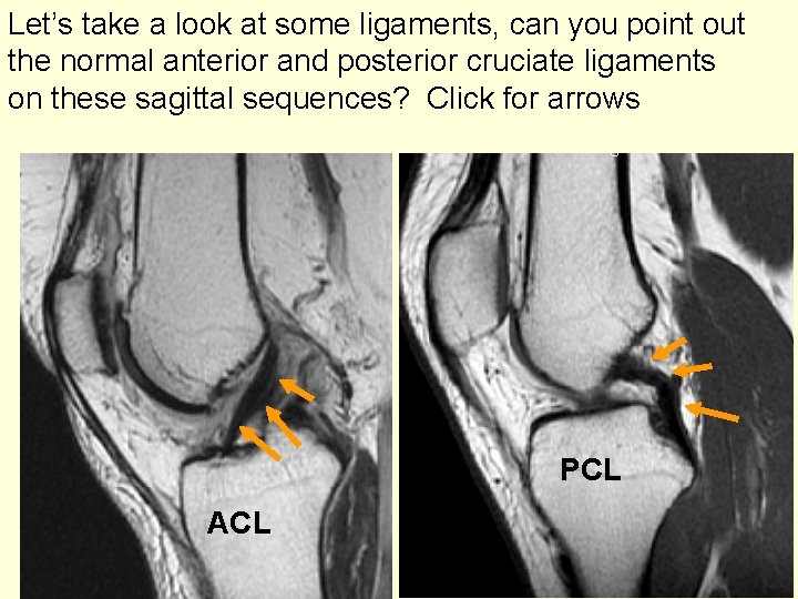 Let’s take a look at some ligaments, can you point out the normal anterior