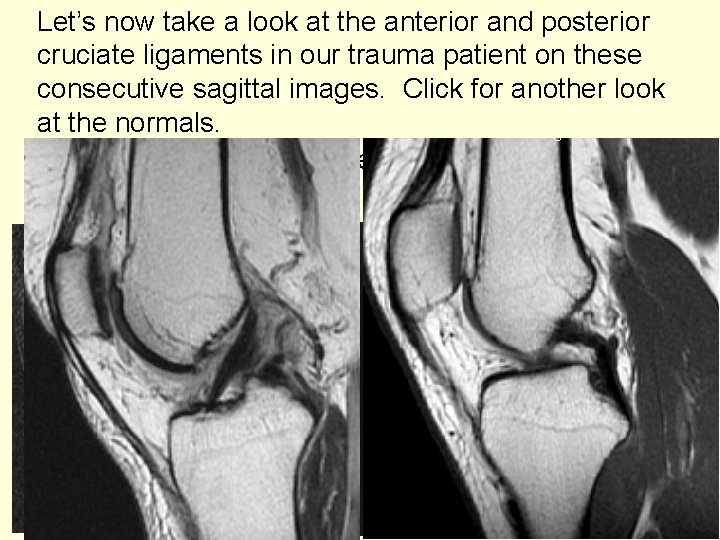 Let’s now take a look at the anterior and posterior cruciate ligaments in our