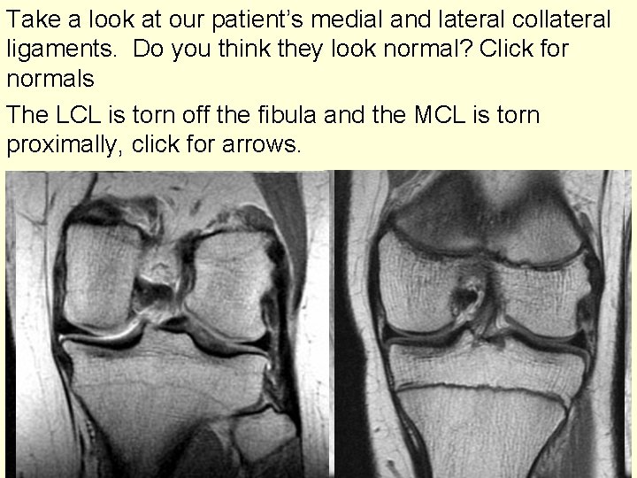 Take a look at our patient’s medial and lateral collateral ligaments. Do you think