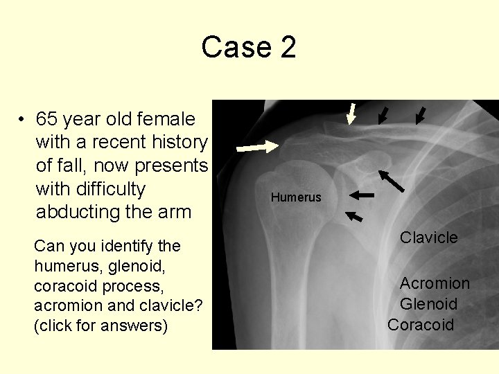 Case 2 • 65 year old female with a recent history of fall, now