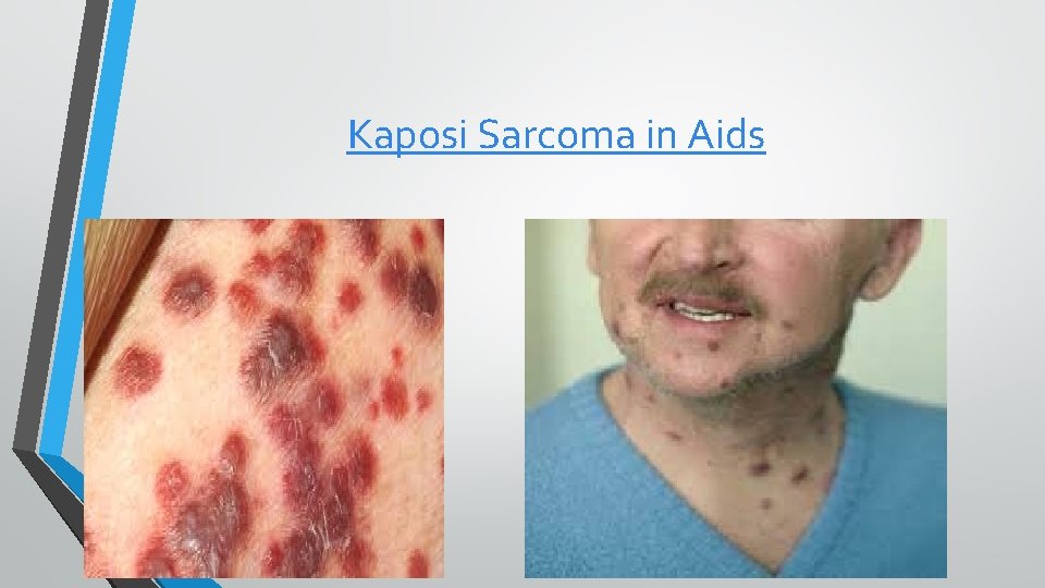 Kaposi Sarcoma in Aids 