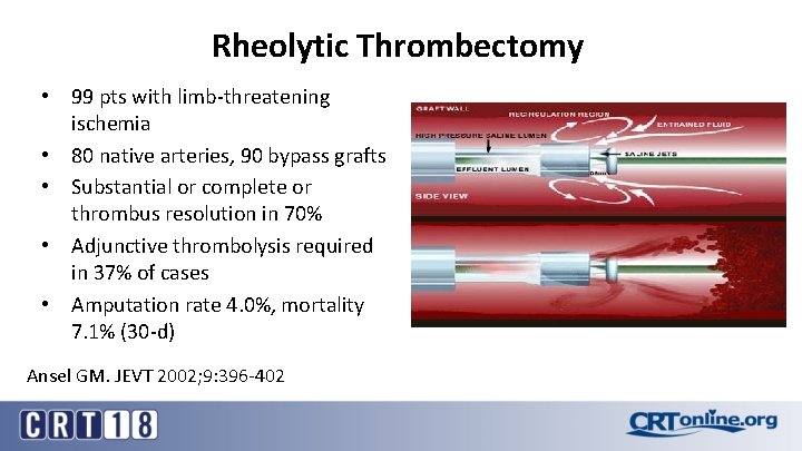 Rheolytic Thrombectomy • 99 pts with limb-threatening ischemia • 80 native arteries, 90 bypass