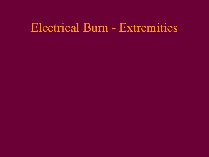 Electrical Burn - Extremities 