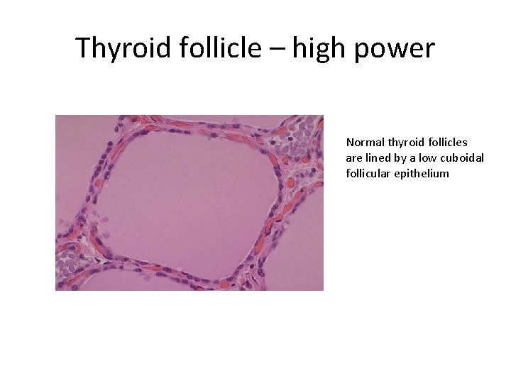 Thyroid follicle – high power Normal thyroid follicles are lined by a low cuboidal