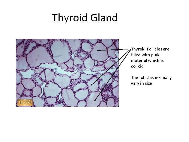 Thyroid Gland Thyroid Follicles are filled with pink material which is colloid The follicles