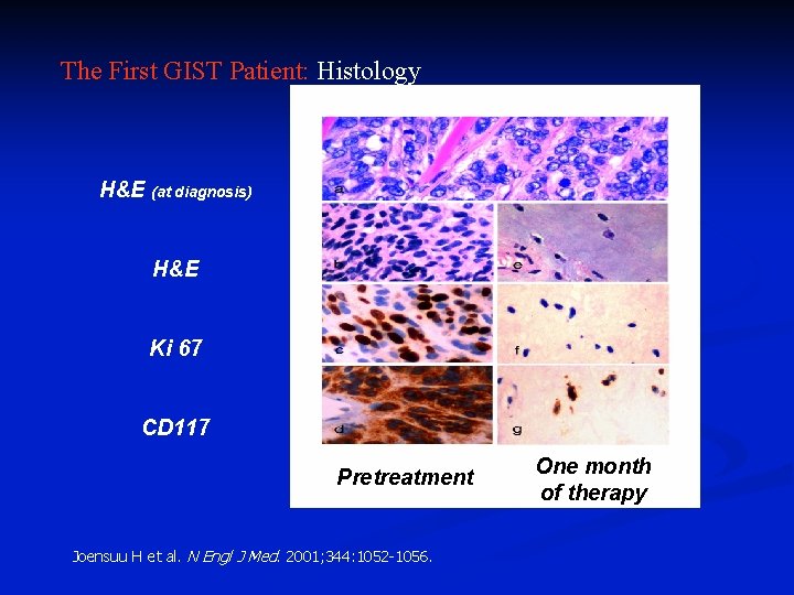 The First GIST Patient: Histology H&E (at diagnosis) H&E Ki 67 CD 117 Pretreatment