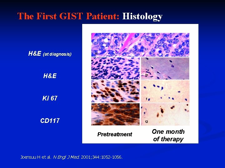 The First GIST Patient: Histology H&E (at diagnosis) H&E Ki 67 CD 117 Pretreatment