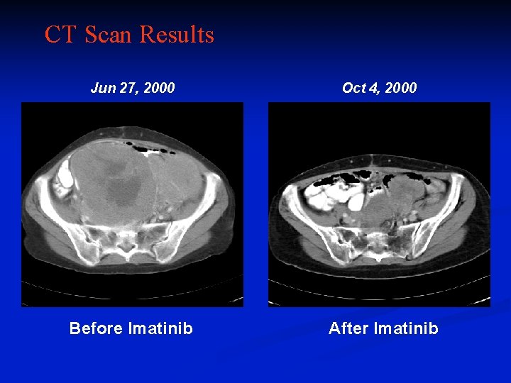 CT Scan Results Jun 27, 2000 Before Imatinib Oct 4, 2000 After Imatinib 