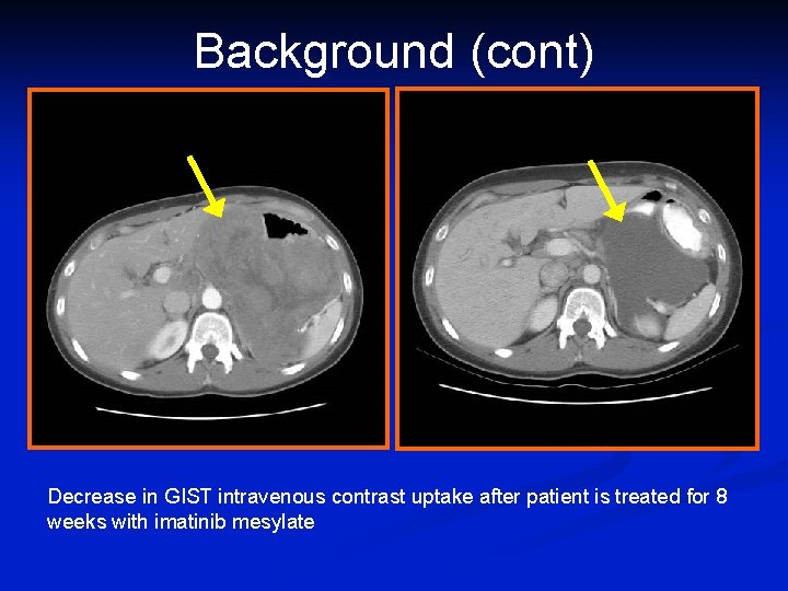Background (cont) Decrease in GIST intravenous contrast uptake after patient is treated for 8