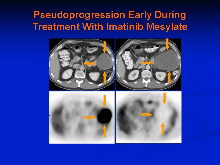Pseudoprogression Early During Treatment With Imatinib Mesylate CT 18 FDG-PET Pre-imatinib mesylate Choi et