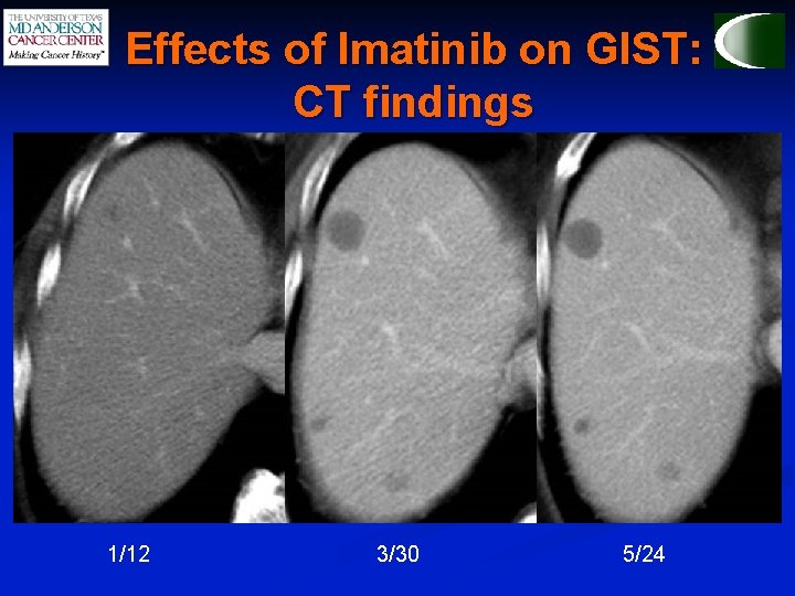 Effects of Imatinib on GIST: CT findings 1/12 3/30 5/24 