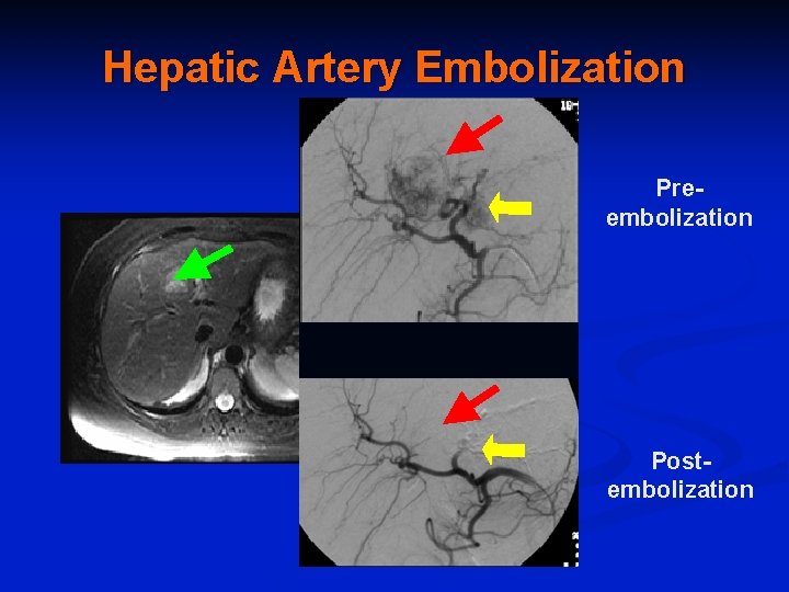 Hepatic Artery Embolization Preembolization Postembolization Courtesy of Dr. R. De. Matteo. 