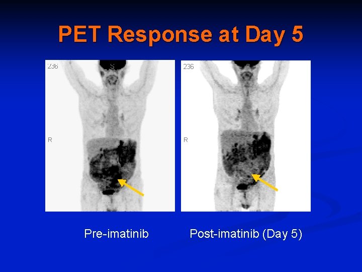 PET Response at Day 5 Pre-imatinib Post-imatinib (Day 5) 
