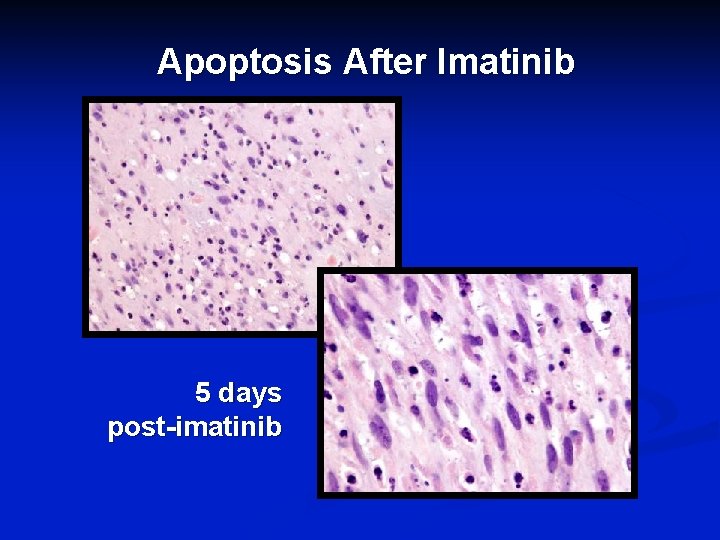 Apoptosis After Imatinib 5 days post-imatinib 