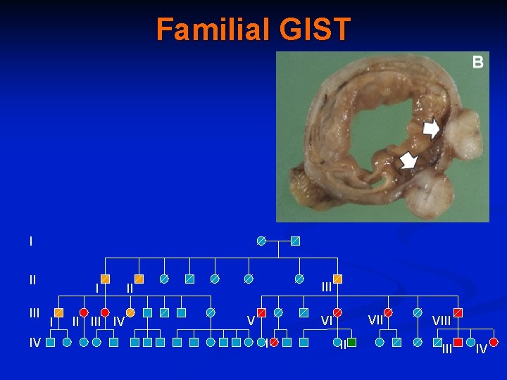 Familial GIST I II III IV III II V VII VI I II VIII