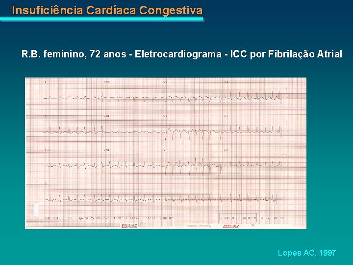 Insuficiência Cardíaca Congestiva R. B. feminino, 72 anos - Eletrocardiograma - ICC por Fibrilação