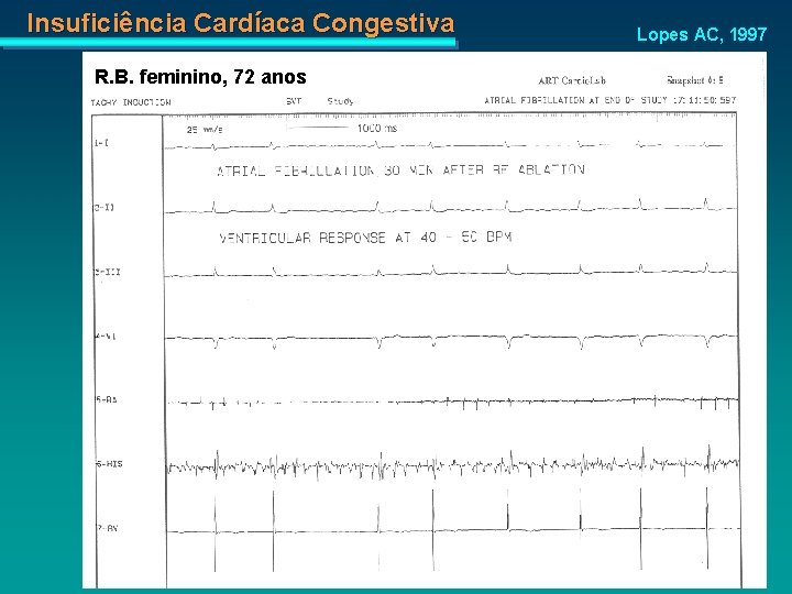 Insuficiência Cardíaca Congestiva R. B. feminino, 72 anos Lopes AC, 1997 