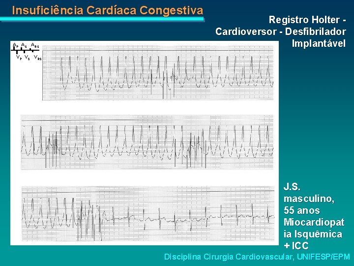 Insuficiência Cardíaca Congestiva AP AS ARS Registro Holter Cardioversor - Desfibrilador Implantável VP VS