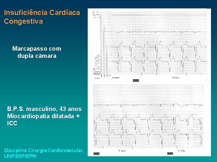 Insuficiência Cardíaca Congestiva Marcapasso com dupla câmara B. P. S. masculino, 43 anos Miocardiopatia Insuficiência Cardíaca Congestiva Marcapasso com dupla câmara B. P. S. masculino, 43 anos Miocardiopatia
