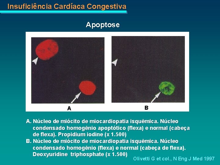 Insuficiência Cardíaca Congestiva Apoptose A B A. Núcleo de miócito de miocardiopatia isquêmica. Núcleo