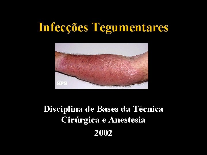 Infecções Tegumentares Disciplina de Bases da Técnica Cirúrgica e Anestesia 2002 