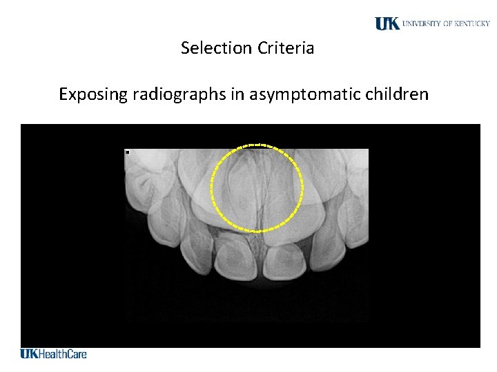 Selection Criteria Exposing radiographs in asymptomatic children 