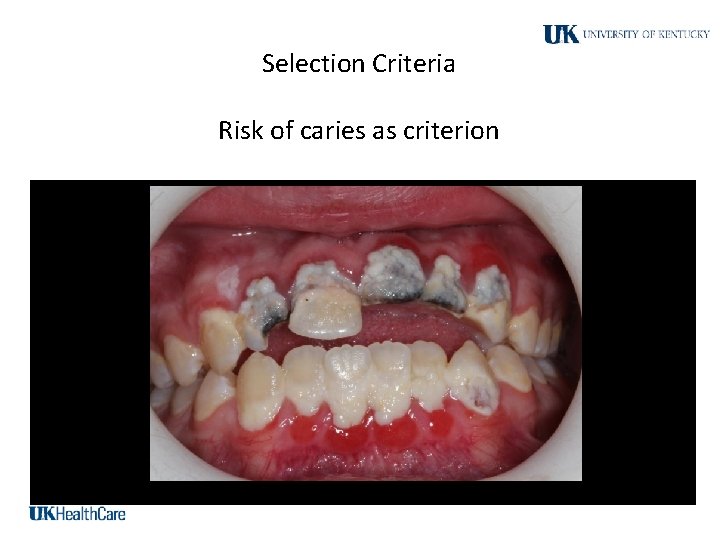 Selection Criteria Risk of caries as criterion 