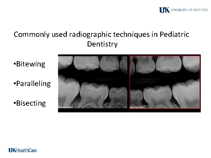 Commonly used radiographic techniques in Pediatric Dentistry • Bitewing • Paralleling • Bisecting 