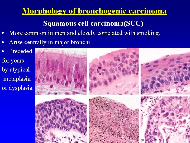 Morphology of bronchogenic carcinoma Squamous cell carcinoma(SCC) • More common in men and closely